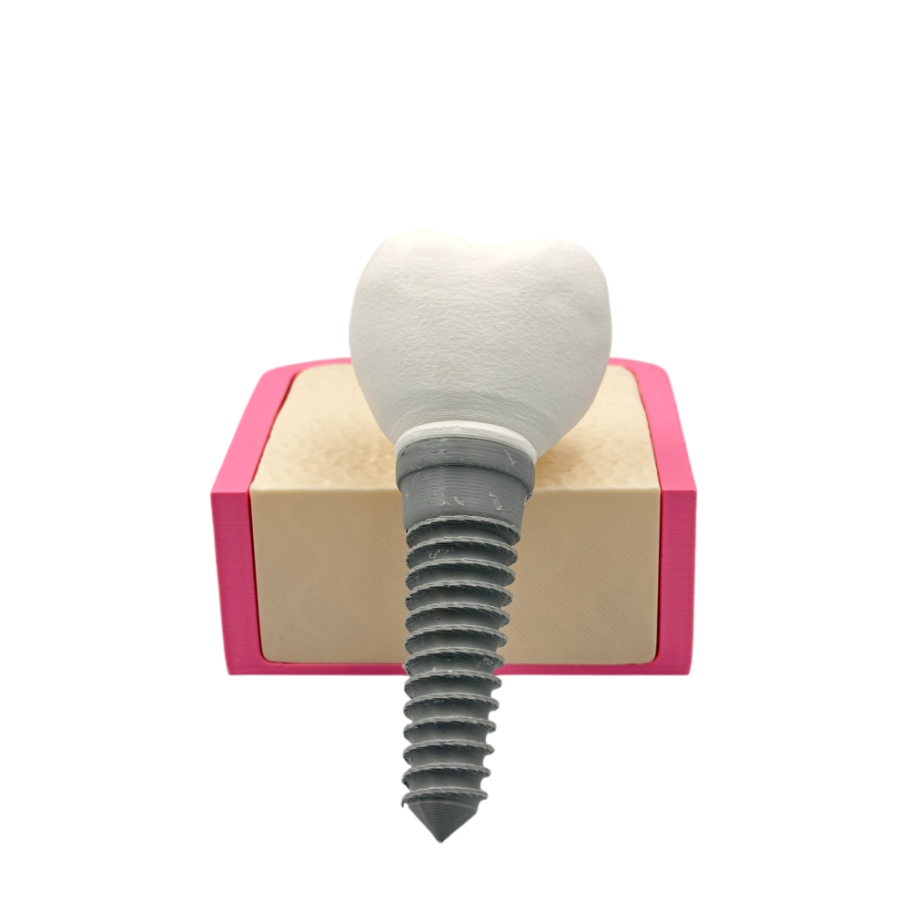 Interactive Dental Implant Anatomical Model