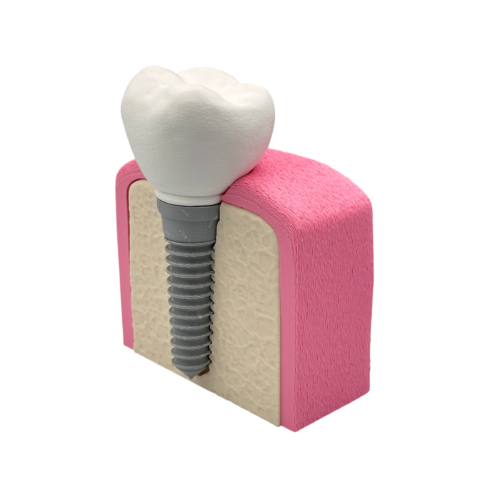 Interactive Dental Implant Anatomical Model