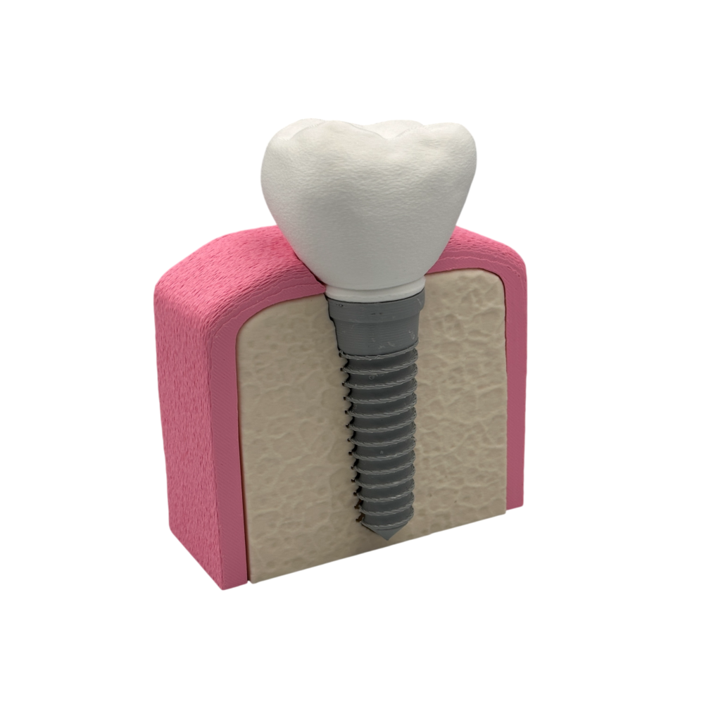 Interactive Dental Implant Anatomical Model