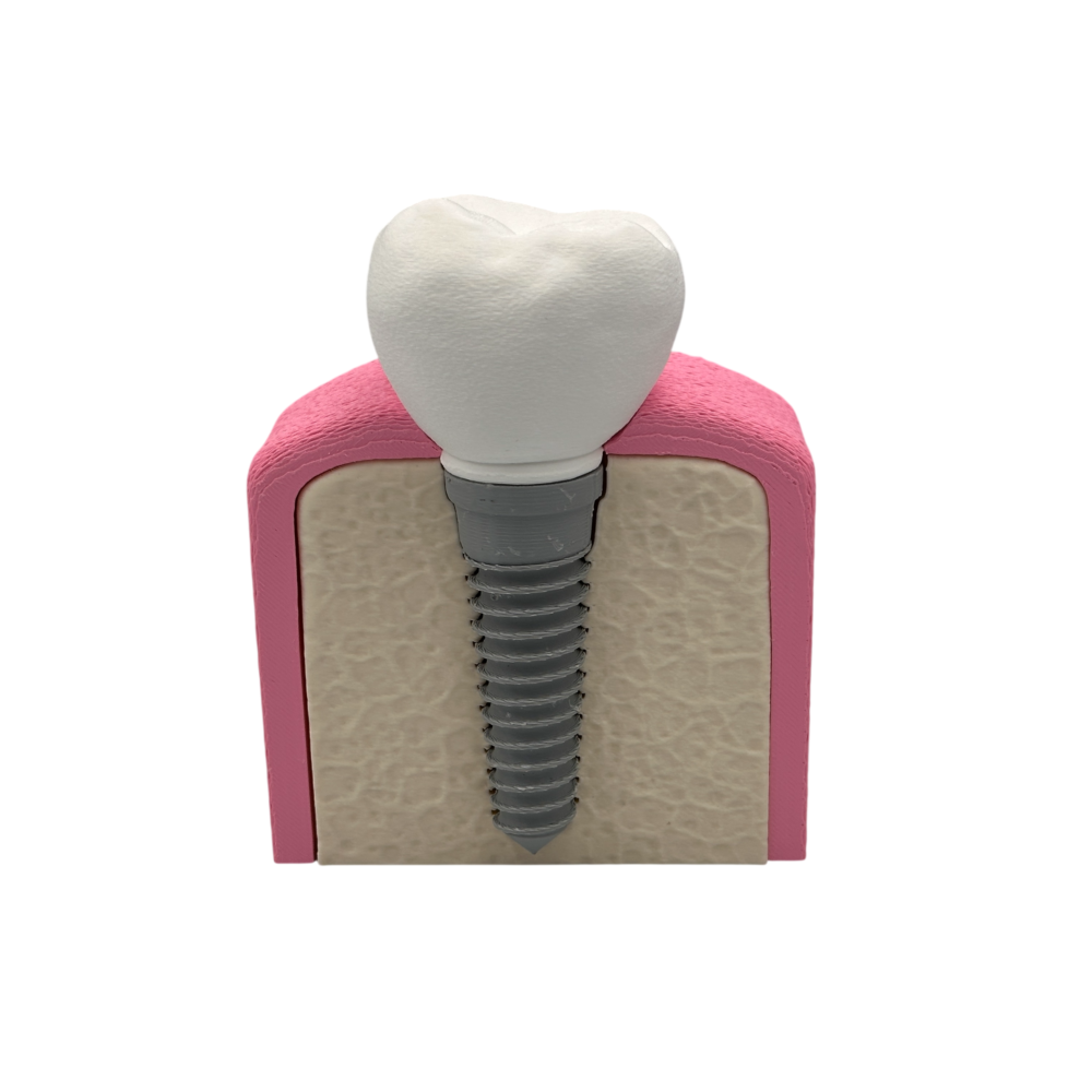 Interactive Dental Implant Anatomical Model